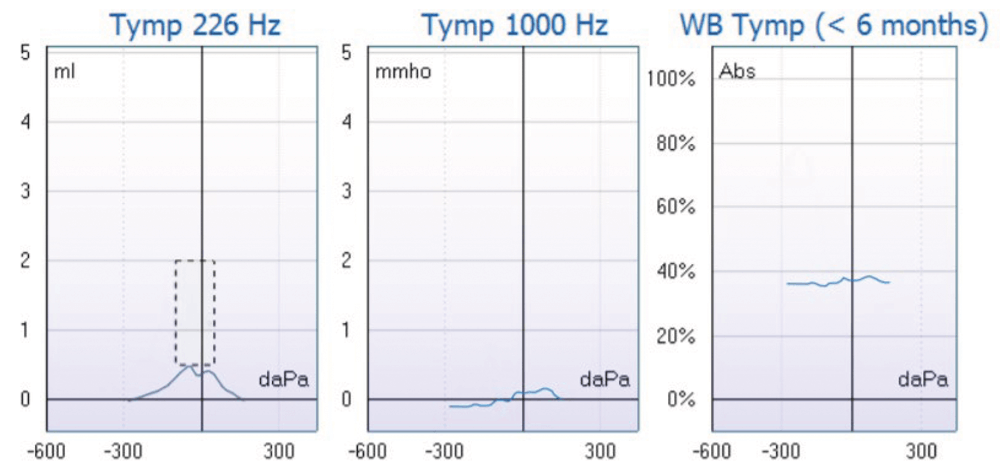 Multifrequency Tympanometry | ENT & Audiology News