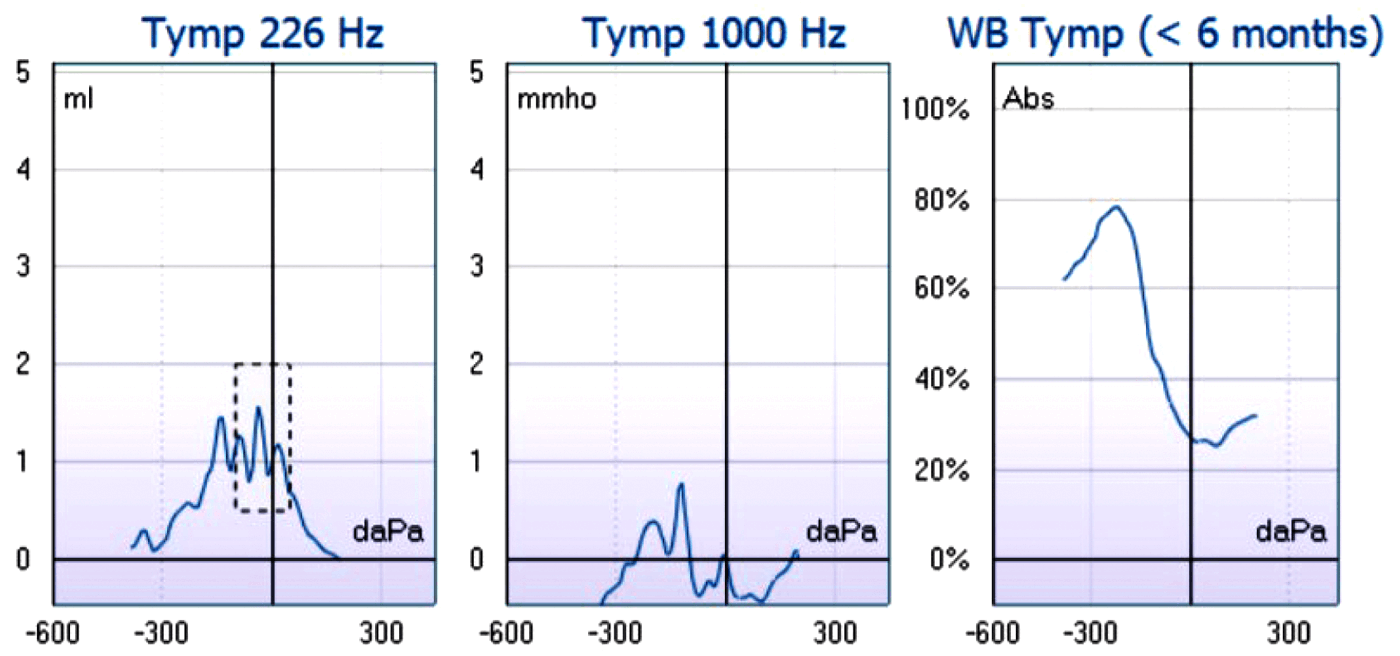 Multifrequency Tympanometry | ENT & Audiology News