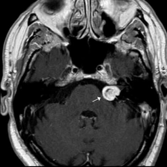 Hearing rehabilitation after vestibular schwannoma surgery | ENT ...