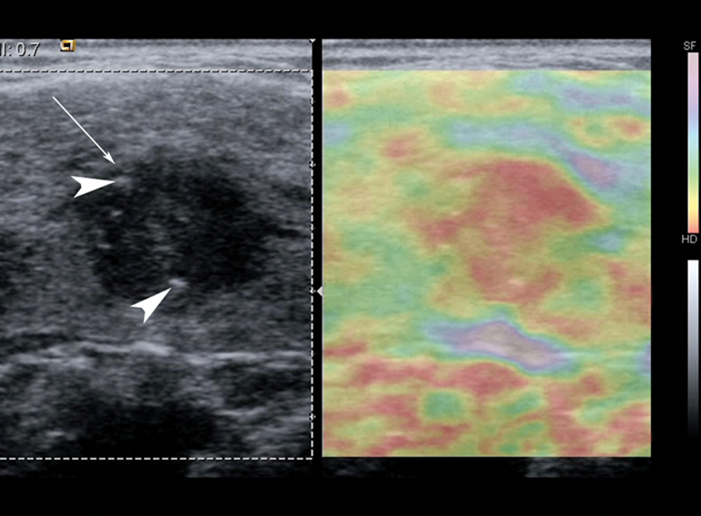 Thyroid Ultrasound Elastography Does Nodule Stiffness Predict Malignancy Ent And Audiology News 4833