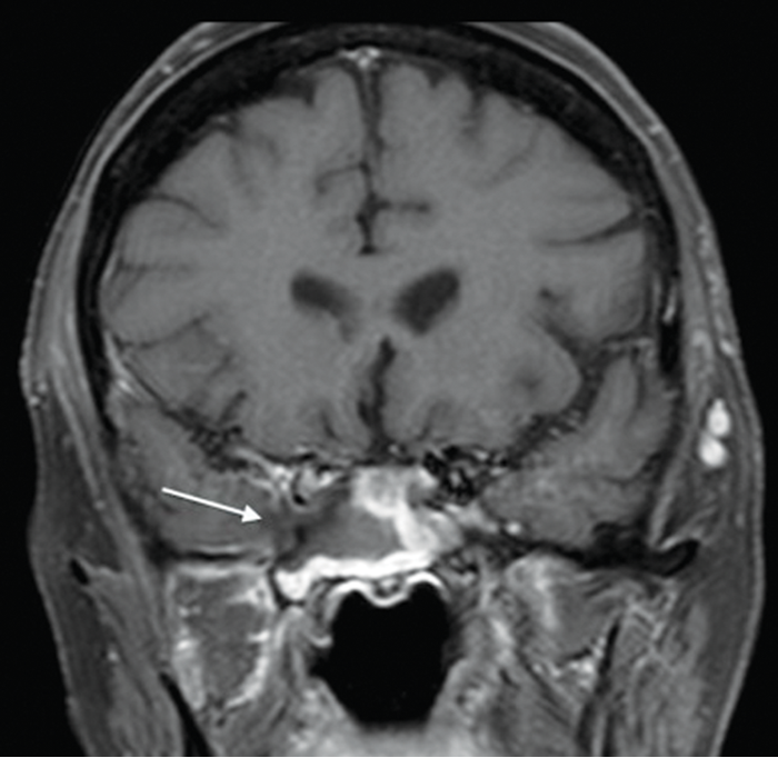 Radiology And Sinus Disease The Ever Evolving Landscape Ent Audiology News