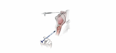 Soluvos Medical Renú® Voice Injectable Implant