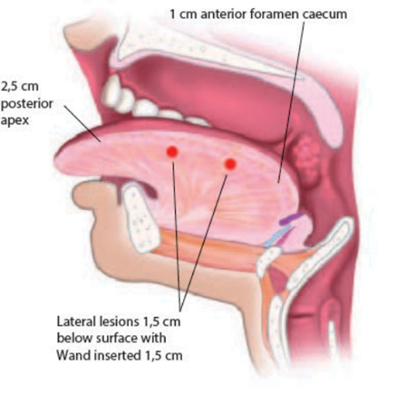 Coblation Tongue Channelling Ent Audiology News