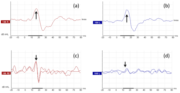 Advances In Vestibular Function Testing | ENT & Audiology News