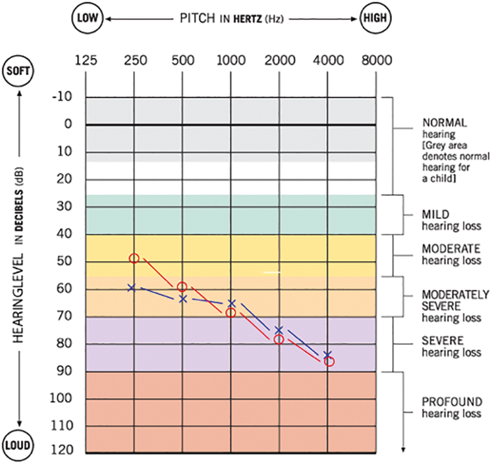 Cochlear Implants For Children | ENT & Audiology News